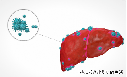 肝病有几种类型?