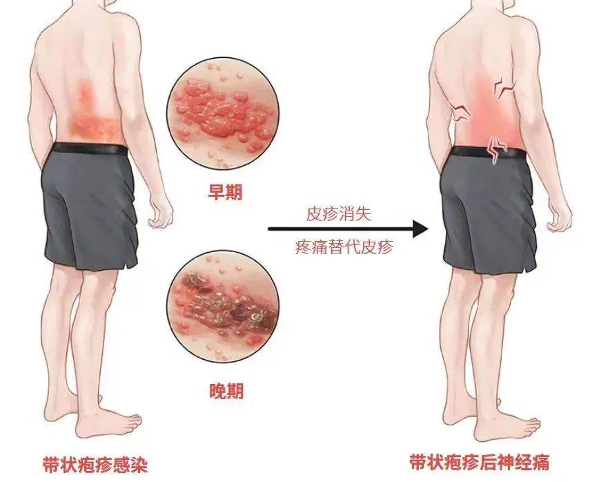 一旦感染终身携带<strong></p>
<p>IBOX</strong>！深圳疾控提醒：这4类人要注意