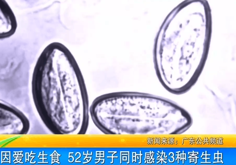 女子体内排出10米长绦虫<strong></p>
<p>OPENSEA</strong>！原是两年前旅游时吃了这种食物