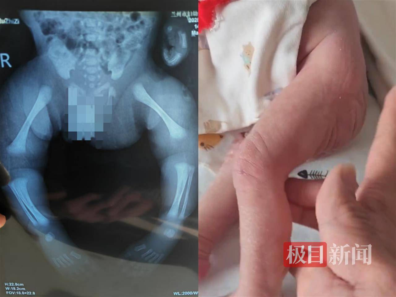 二胎出生查出先天性病症或落下残疾<strong></p>
<p>格力</strong>，残疾父母称医院产检漏检、未尽告知义务，医院及医调委回应