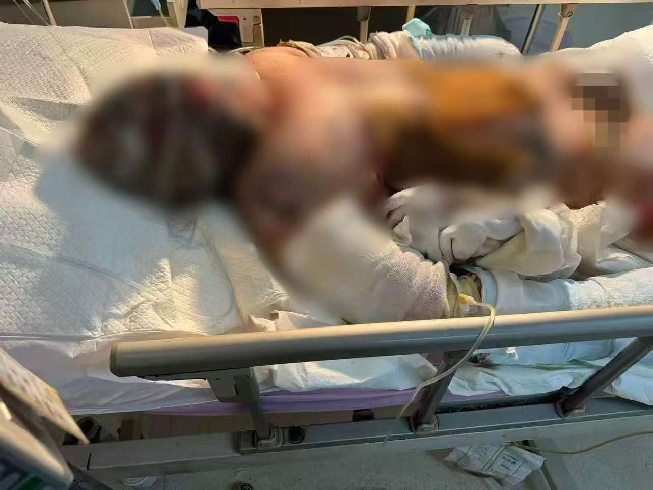 父子在哈尔滨一亲戚公司上班遇爆炸全身烧伤<strong></p>
<p>抹茶交易所</strong>,治疗花费近百万公司拒赔偿?亲戚回应