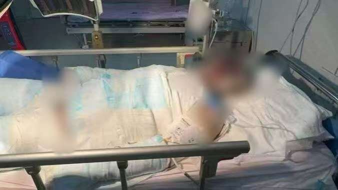 父子在哈尔滨一亲戚公司上班遇爆炸全身烧伤<strong></p>
<p>抹茶交易所</strong>,治疗花费近百万公司拒赔偿?亲戚回应