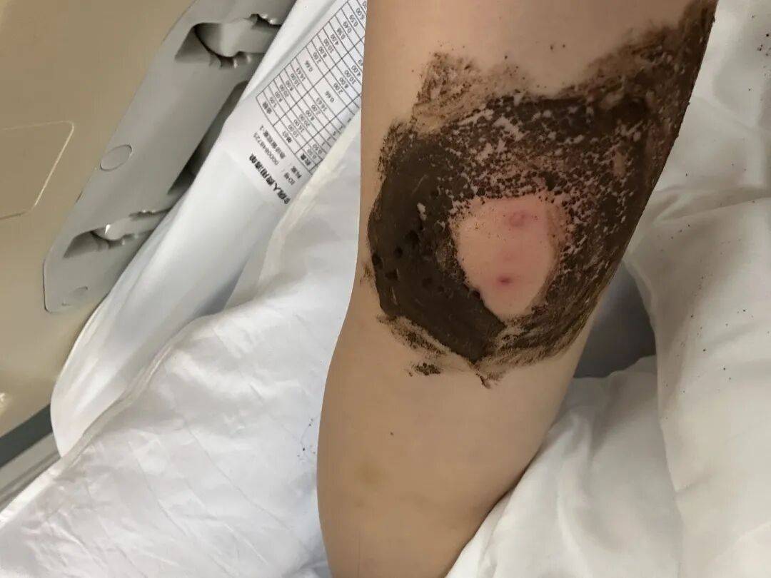 4名游客景区内遭马蜂袭击<strong></p>
<p>抹茶交易所</strong>,旅游度假区:是森林公园不卖门票,蜇伤先就医后提供证据投诉