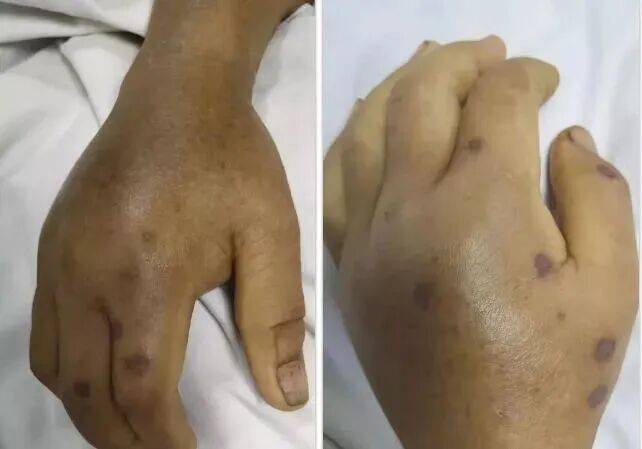 深圳一市民突遭马蜂围袭!已进入高发期<strong></p>
<p>抹茶交易所</strong>,千万别招惹!